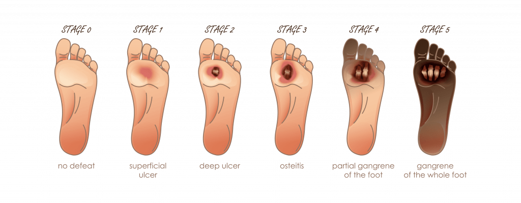classification of diabetic foot ulcers