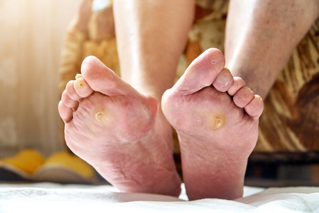 diabetic foot ulcer causes and treatment